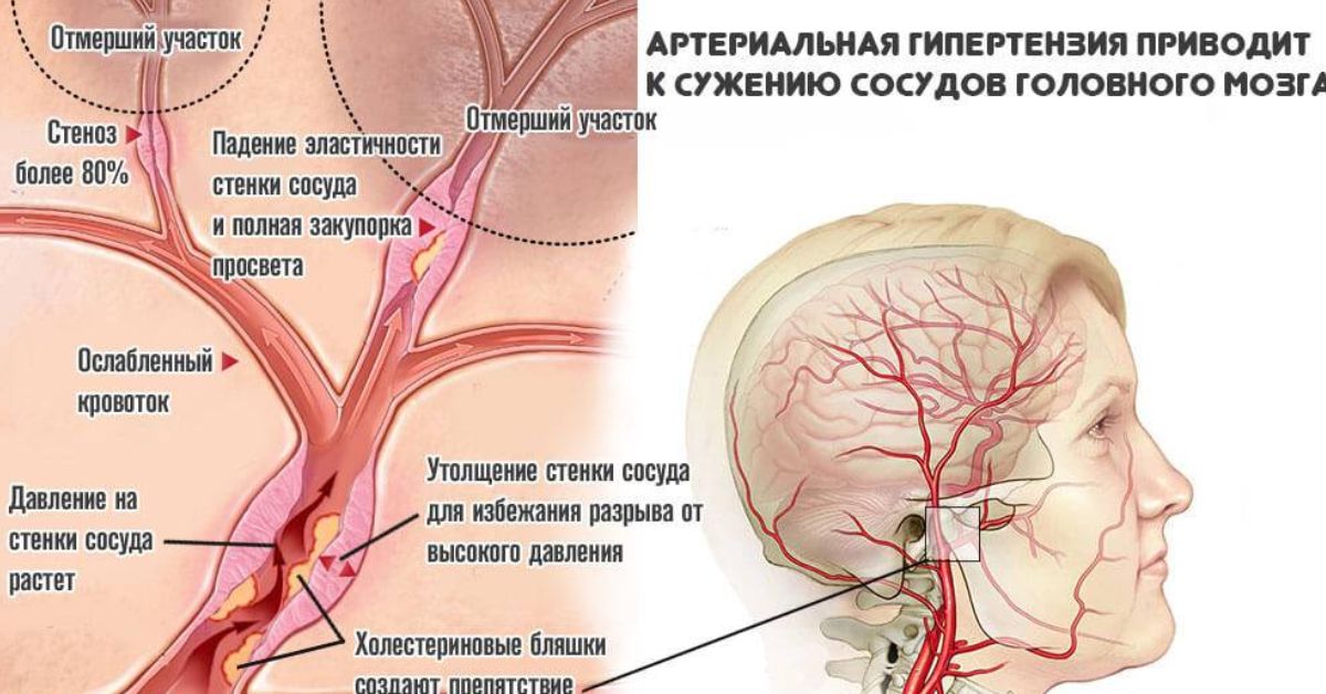 Почему сделать сосуды. Сужение сосудов головного мозга. Расширение артерий головного мозга. Артерии и сосуды головного мозга.