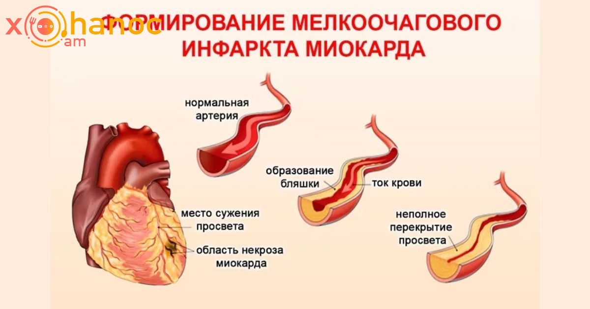 Инфаркт миокарда симптомы первые признаки и лечение. Мелкоочаговый инфаркт. Мелко очпговый инфаркт. Инфаркт миокарда симптомы. Крупноочаговый и мелкоочаговый инфаркт миокарда.