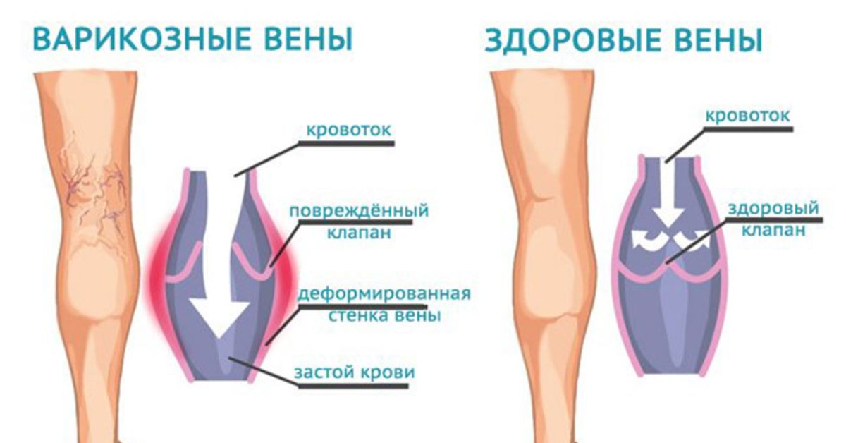 Внутреннее расширение. Варикозное расширение вен нижних конечностей. Массаж при варикозе нижних конечностей.