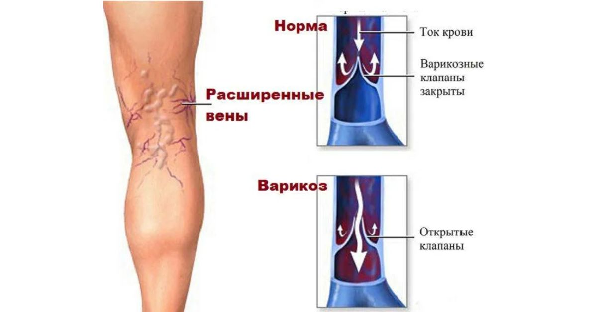 Почему варикоз. Варикозное расширение вен нижних конечностей анатомия. Варикозное расширение вен нижних конечностей узлы. Варикозное расширение вен ХВН 1 степени.