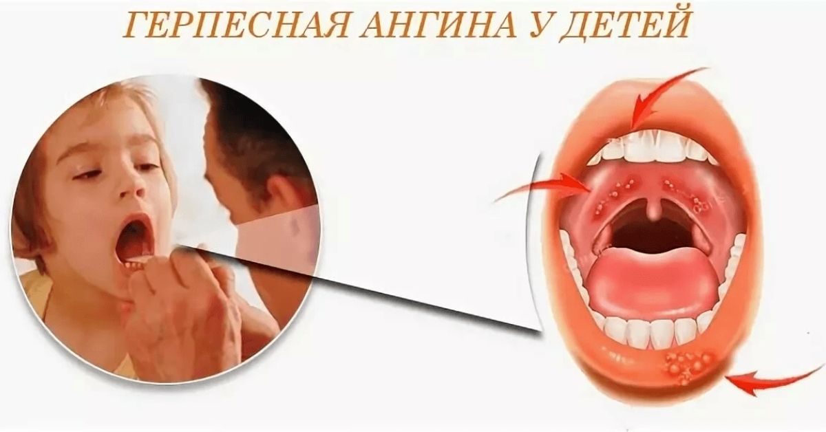 Сыпь температура боль в горле у ребенка. Вирусная герпесная ангина сыпь. Герпесвирусный фарингит.