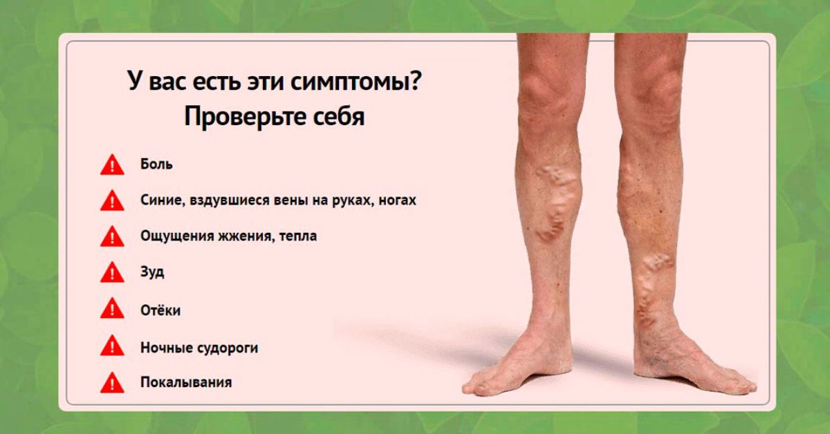 От чего болят ноги у мужчин. Симптомы варикоза на ногах симптомы. Симптомы варикозного расширения.
