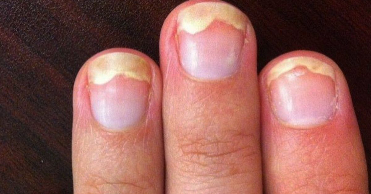 Онихолизис ногтей на руках фото чем лечить