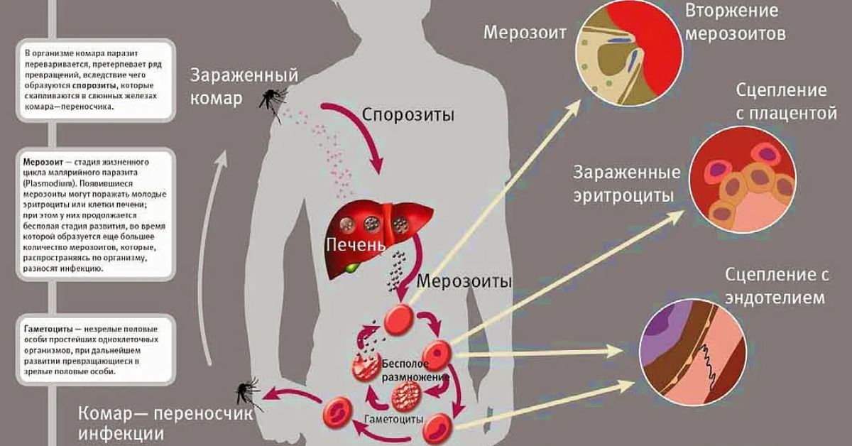 Малярию могут вызывать. Малярийный плазмодий это бактерия. Малярийный плазмодий заболевание. Симптомы болезни малярийного плазмодия. Заражение малярийным плазмодием.