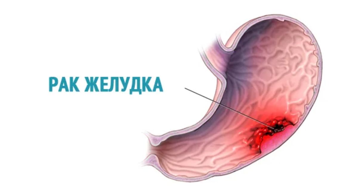 Рак желудка у мужчины. Каллезная язва желудка. Раковая опухоль желудка. Злокачественное новообразование желудка.