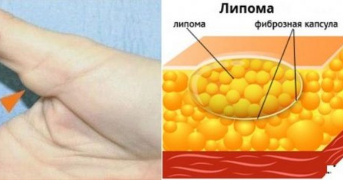 Бывшие желтые тела. Фиброз подкожно жировой клетчатки. Липома доброкачественная опухоль жировой ткани. Липоматоз жировой клетчатки.