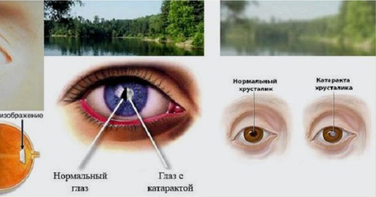 Почему мутно видно. Ретинопатия катаракта глаукома. Катаракта схема глаза. Нормальный глаз и катаракта. Зрение человека с катарактой.