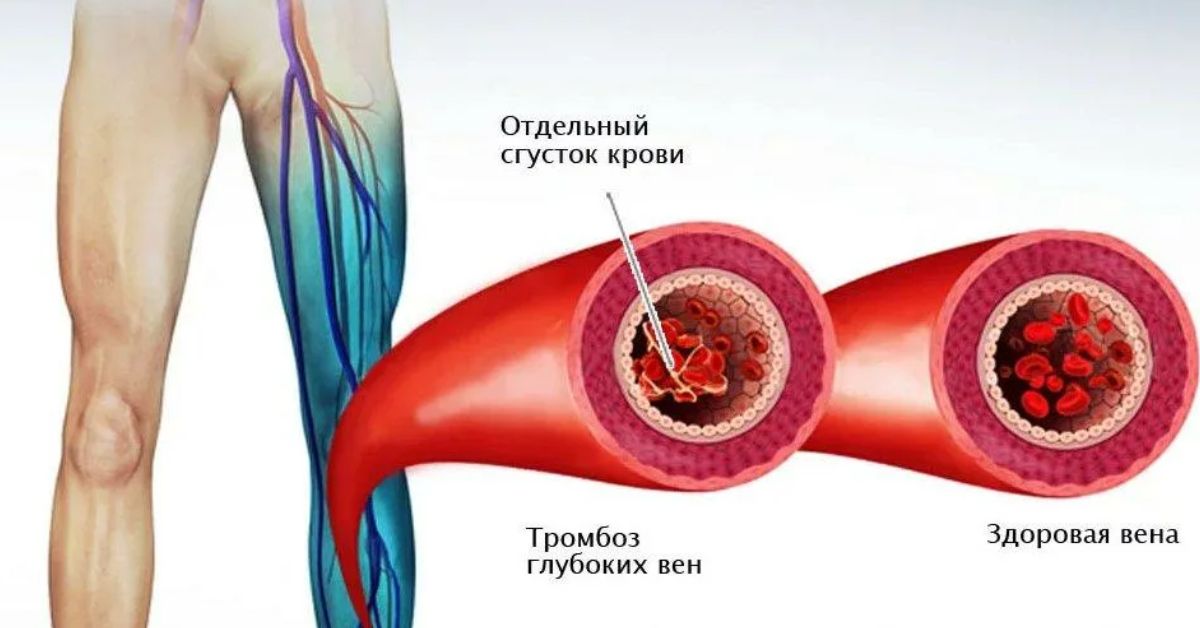 Коронавирус тромбы