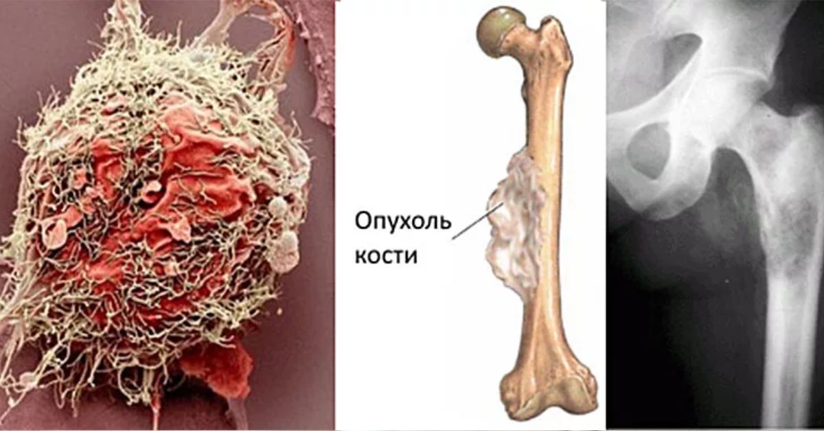 Опухоли костей. Саркома Юинга трубчатой кости. Опухоль Юинга бедренной кости. Саркома Юинга опухоль костей. Хондробластическая остеосаркома.