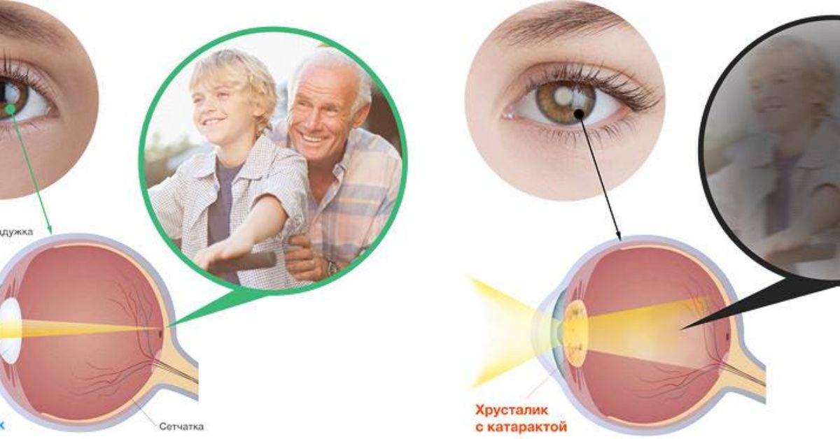 Зрение 1 симптомы. Катаракта симптомы капли. Диабетическая ретинопатия катаракта. Диабетическая ретинопатия глаз. Ретинопатия катаракта глаукома.