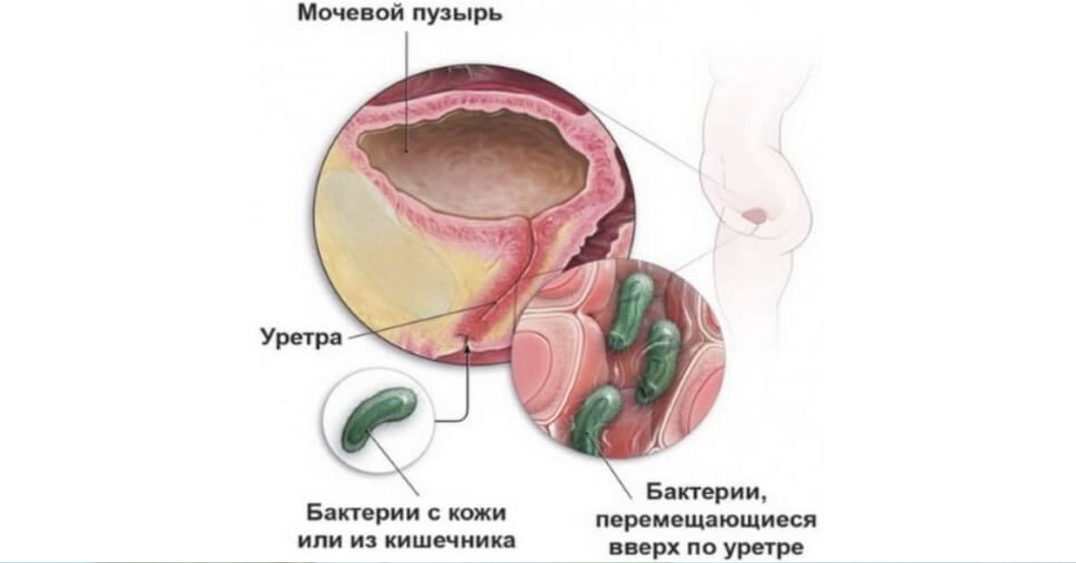 Болезнь мочевого пузыря у женщин лечение. Инфекция мочевого пузыря. Риск инфицирования мочевого пузыря. Уретра у женщин анатомия.