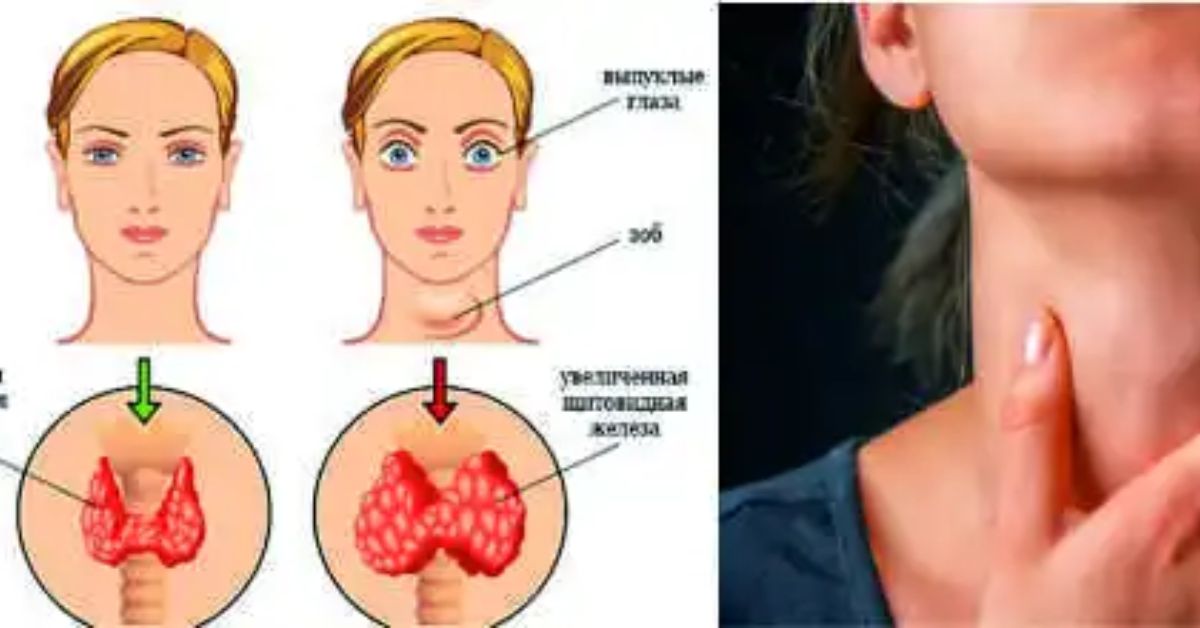 Почему появляются узлы. Расширенная щитовидка. Опухлость щитовидной железы. Щитовидная железа в горле.