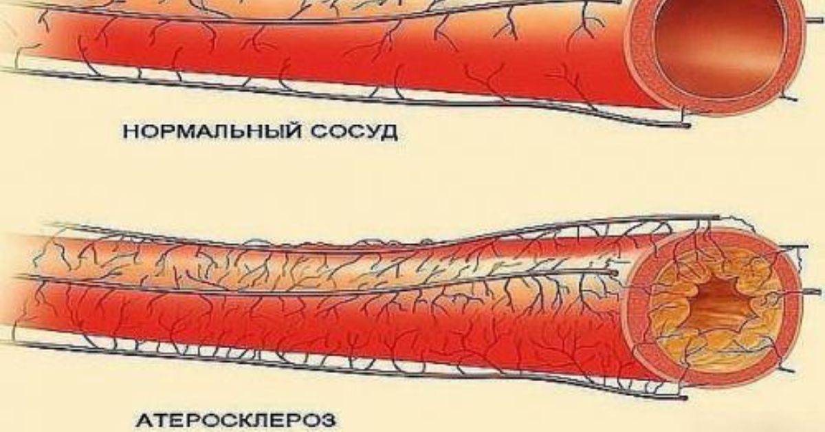 Уз признаки атеросклероза бца. Атеросклероз сосудов брахиоцефальных артерий. Атеросклероз сосудов бца. Брахиоцефальные артерии атеросклероз. Брахиоцефальные сосуды атеросклероз.