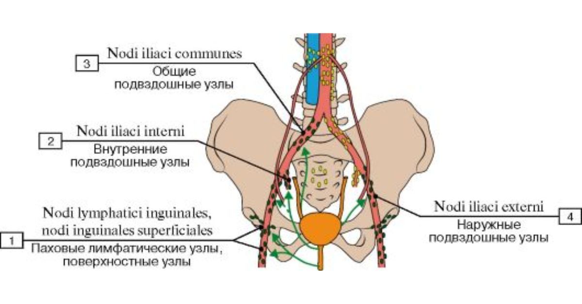 Лимфоузел справа у мужчины. Лимфатические узлы малого таза схема. Наружные подвздошные лимфатические узлы. Подвздошные лимфоузлы строение. Подвздошные лимфоузлы схема.