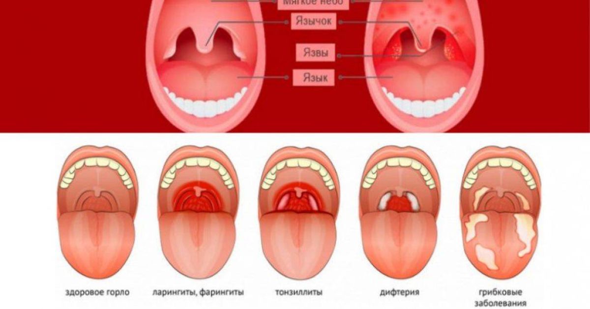 Сыпь температура боль в горле у ребенка. Тонзиллиты фарингиты ларингиты. Различия тонзиллита и фарингита ларингита и ангины. Катаральное воспаление миндалин.