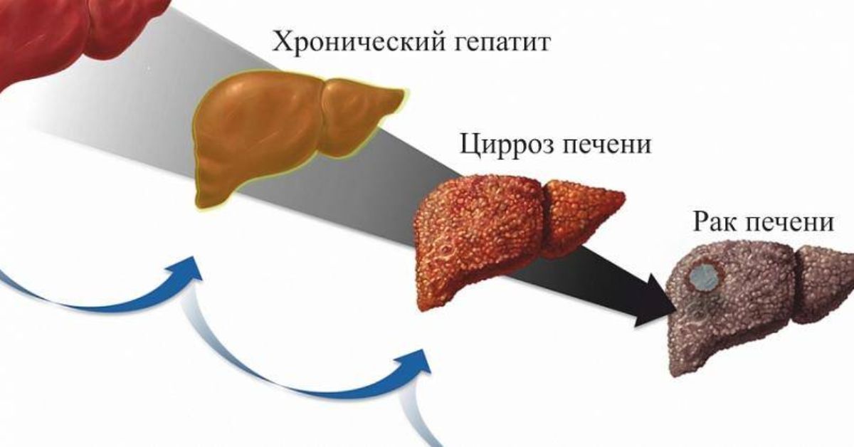 Гепатит в переходит в цирроз. Цирроз после вирусного гепатита. Цирроз печени гепатит b. Хронический гепатит и цирроз печени.