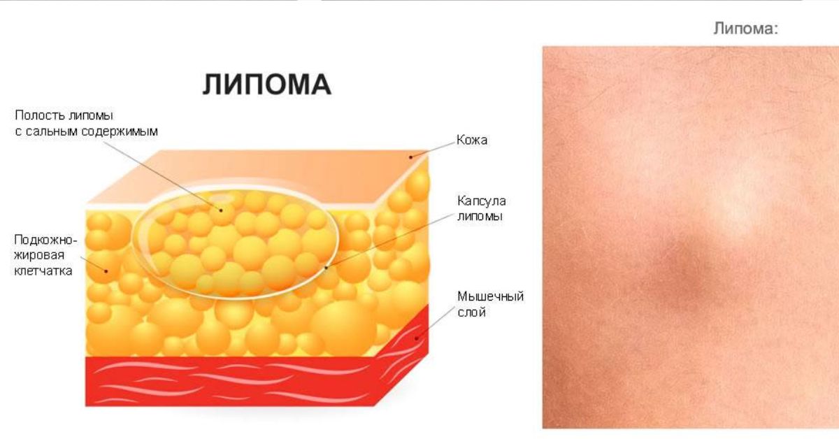 Лимпома. Липома подкожной жировой клетчатки. Доброкачественное новообразование жировой ткани.