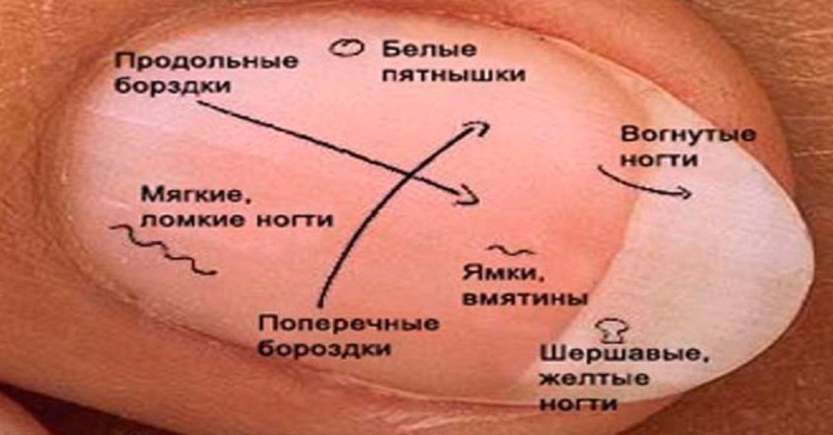 Определить заболевание по рукам. Вид ногтей и здоровье. О чем говорят ногти.