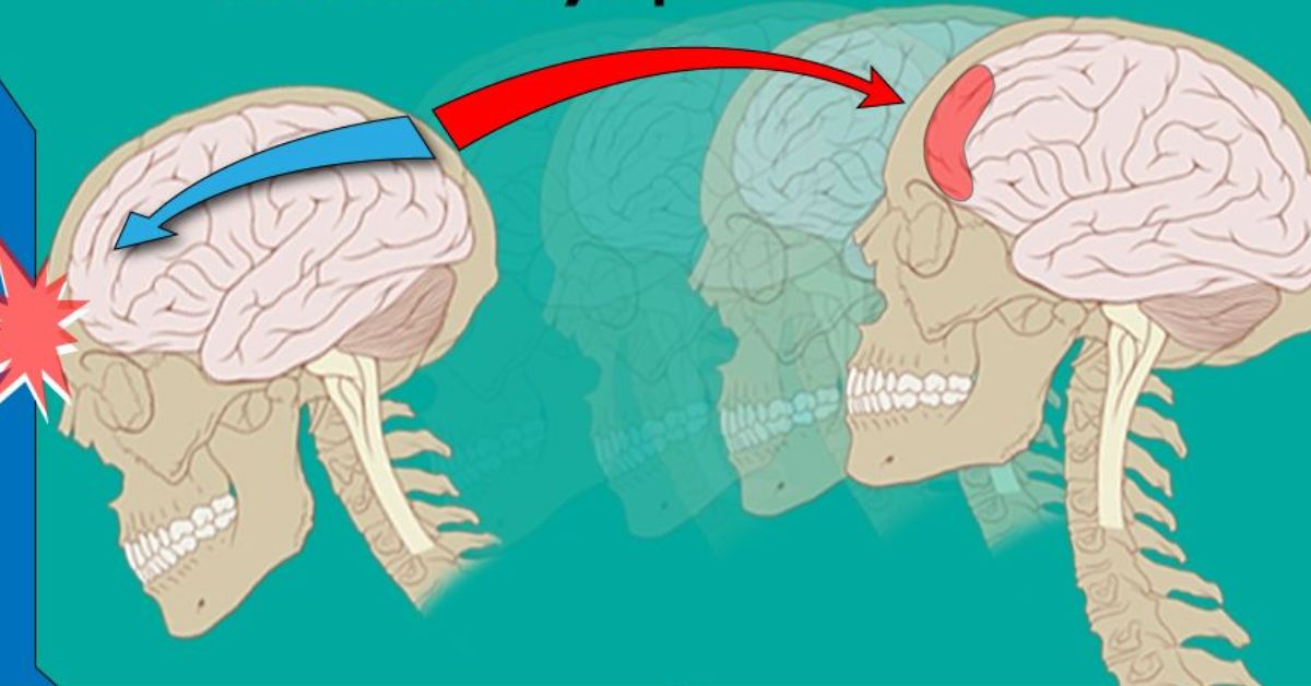 Все проходит через мозг. Сотрясение нерва период восстановления. Как проверить сотрясение головы.