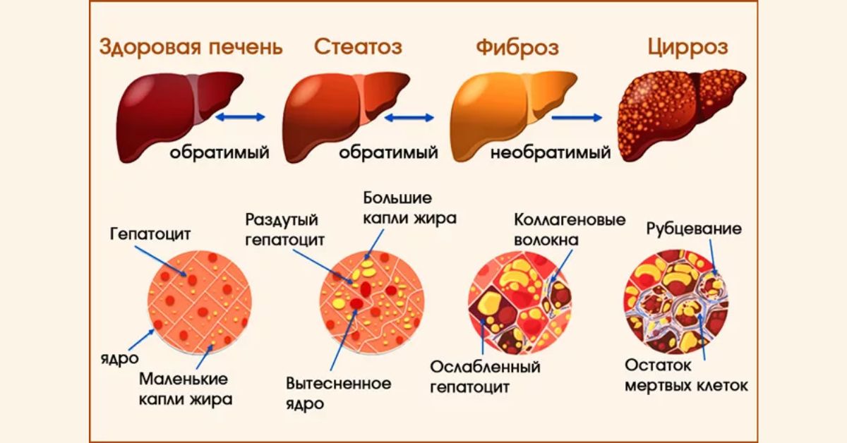 Гепатит обычный. Цирроз печени стадии развития. Стадии формирования цирроза печени. Степени поражения печени при циррозе. Фазы развития цирроза печени.