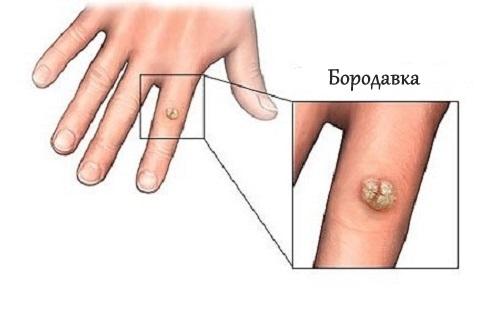 Как лечить бородавку на гениталиях
