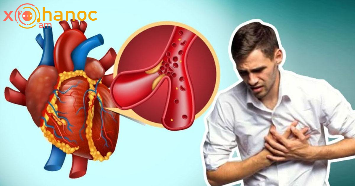 Ինչ է պետք անել և ինչպես օգնես ինքդ քեզ ինֆարկտի ժամանակ. Ունես ընդամենը 10 վակրկյան