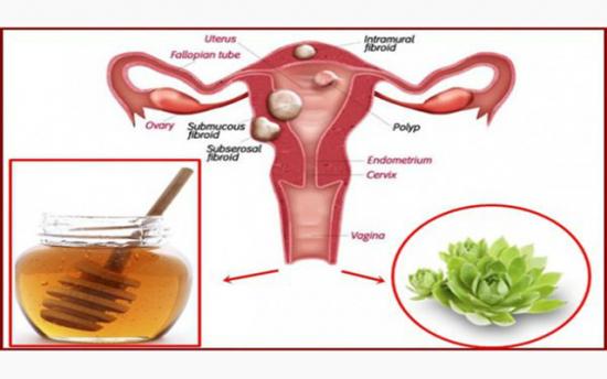 Երկու հրաշալի բաղադրիչներ, որոնք պայքարում են կիստաների և ֆիբրոիդների դեմ