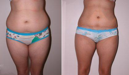 Ճարպերն այրող նոր միջոց՝ առանց դիետաների ու ֆիզիկական վարժությունների