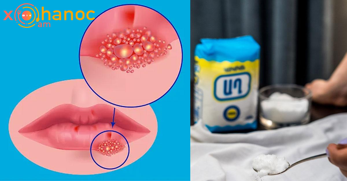 Աղի միջոցով ազատվեք հերպեսից հաշված ժամերի ընթացքում