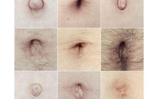 Ի՞նչ թաքնված հիվանդությունների մասին կարող է Ձեզ զգուշացնել Ձեր պորտը