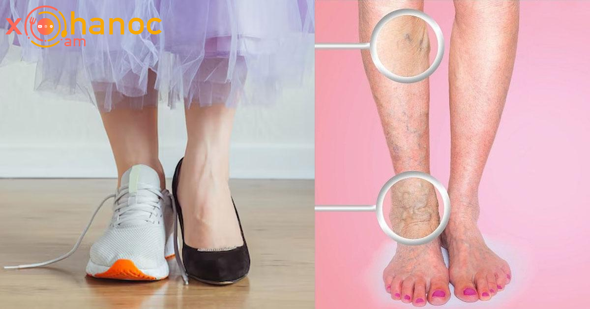 Այս գործոնը նպաստում է վարիկոզին․ Մի արեք այսպես