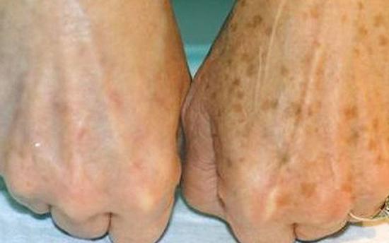 Վերացրեք ձեռքերի շագանակագույն բծերը