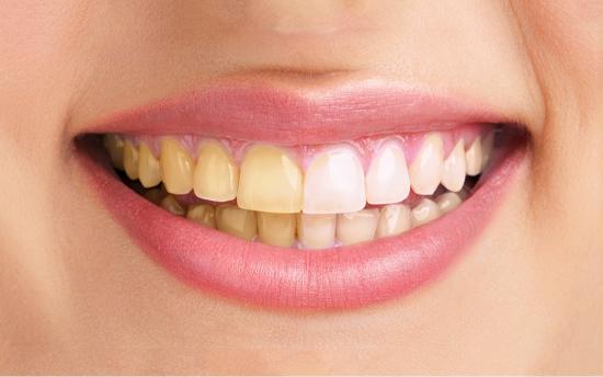 10 պատճառ, թե ինչո՞ւ են ատամները դեղնում