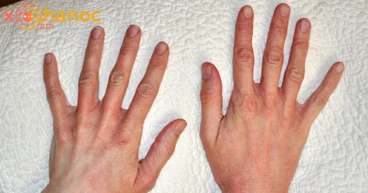 Մաշկի քաղցկեղի աաջին նշանը կարող եք հասկանալ նայելով ձեռքերին և մատներին
