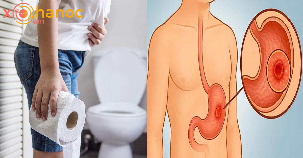 Սա ստամոքսի խոցի ախտանիշ է. Ճանաչեք խոցը վաղ փուլերում