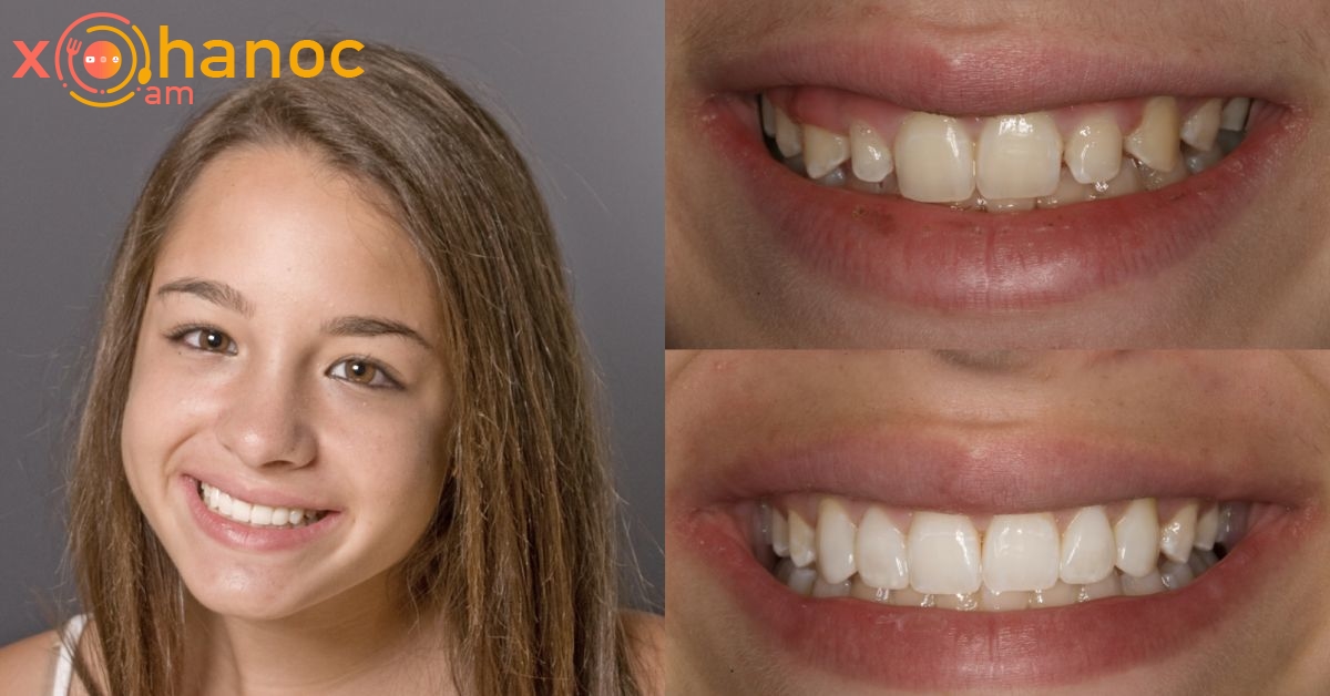 Ինչպես սպիտակեցնել դեղին ատամները ընդամենը 2 րոպեում