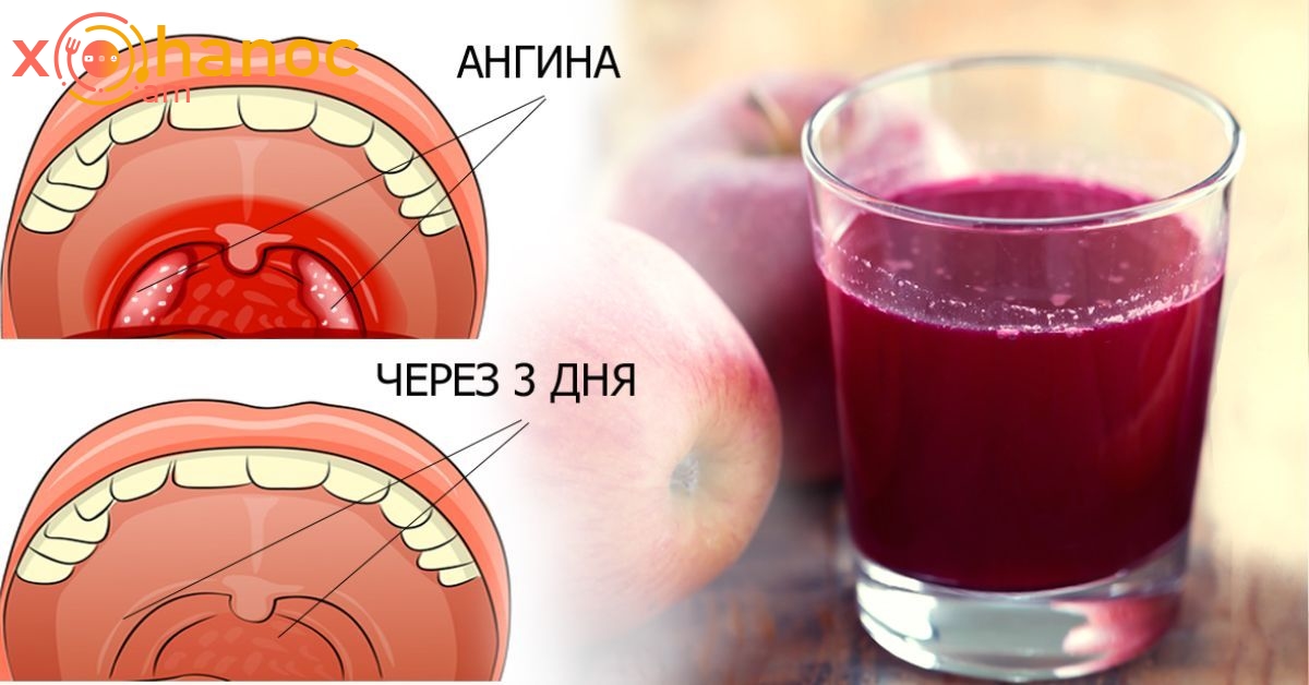 Եթե ​​հանկարծ կոկորդի ցավ ունեք, ապա սա ամենաարդյունավետ մեթոդն է