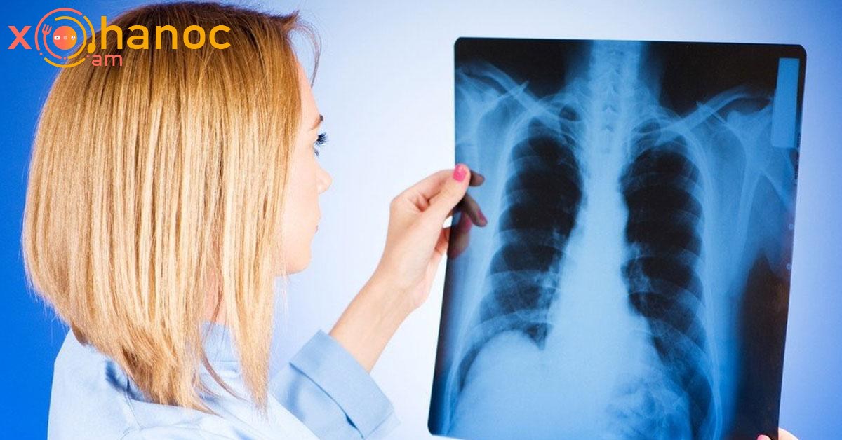 Թոքերի քաղցկեղի այս 8 նշանների և ախտանշանների իմացությունը կյանքեր է փրկում