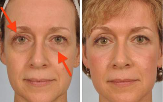 Ձվի սպիտակուցի միջոցով վերացրեք աչքերի տակի պարկերը