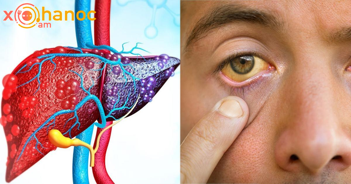 Լյարդի հիվանդության նշանները և ինչպես բուժել լյարդը