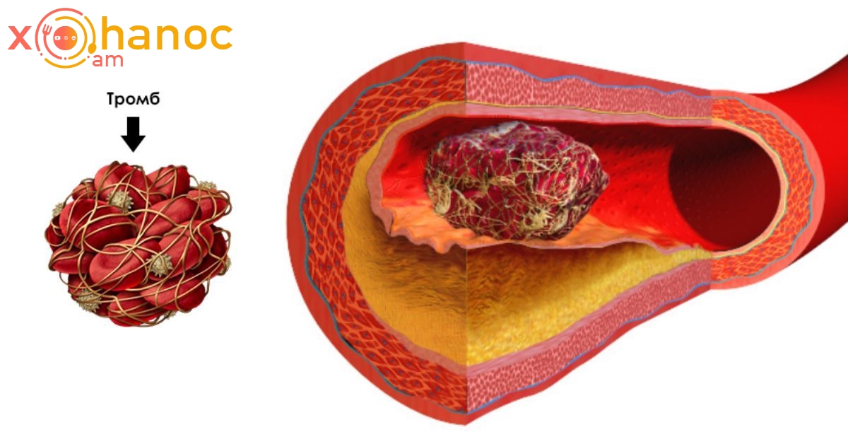 Сгусток в вене. Тромбоз кровеносных сосудов. Тромбоэмболия кровеносного сосуда. Тромб в кровеносном сосуде.