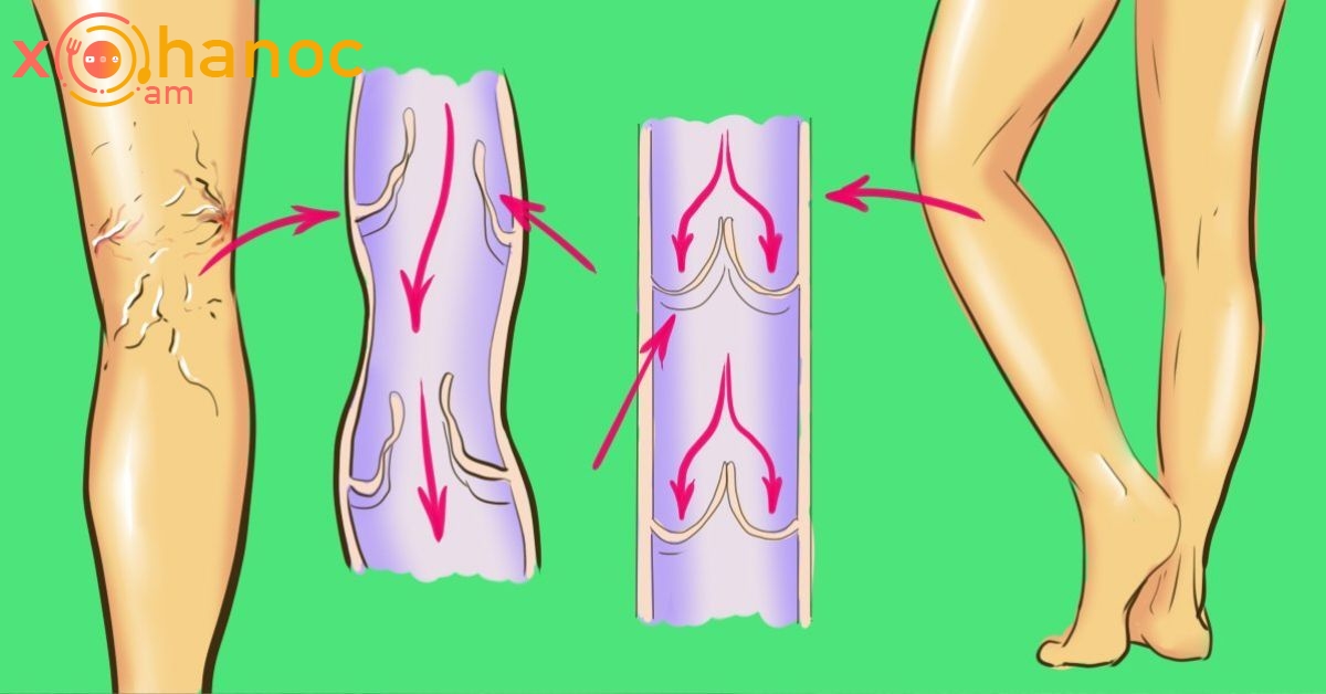 Բոլորն ունեն այս վարիկոզի դեղը, բայց ոչ ոք չգիտի դրա մասին