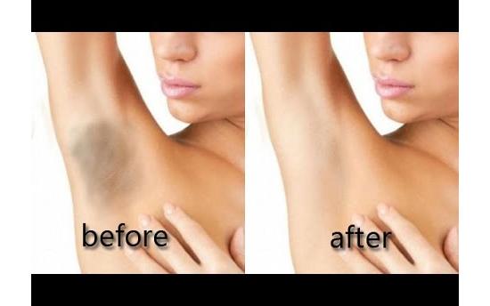 Ինչպե՞ս սպիտակեցնել թևատակերը