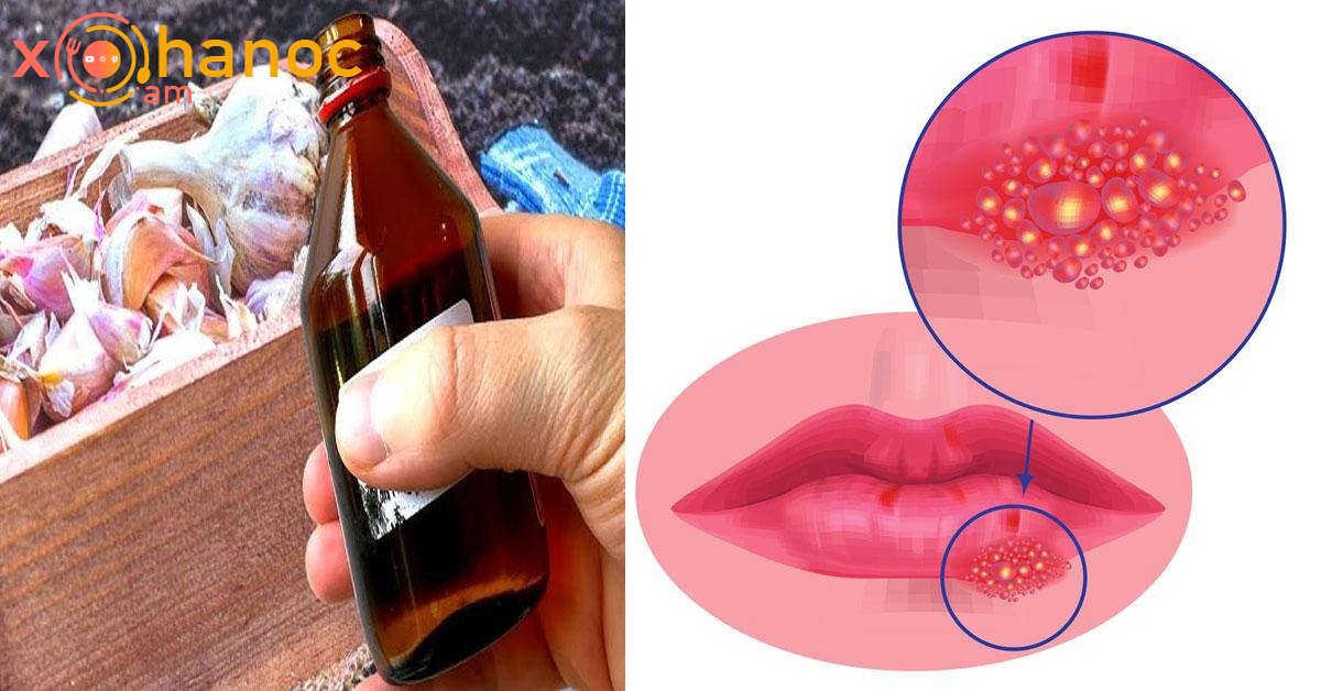 Այս բնական միջոցը սպանում է հերպեսը և վերացնում այն հաշված ժամերի ընթացքում