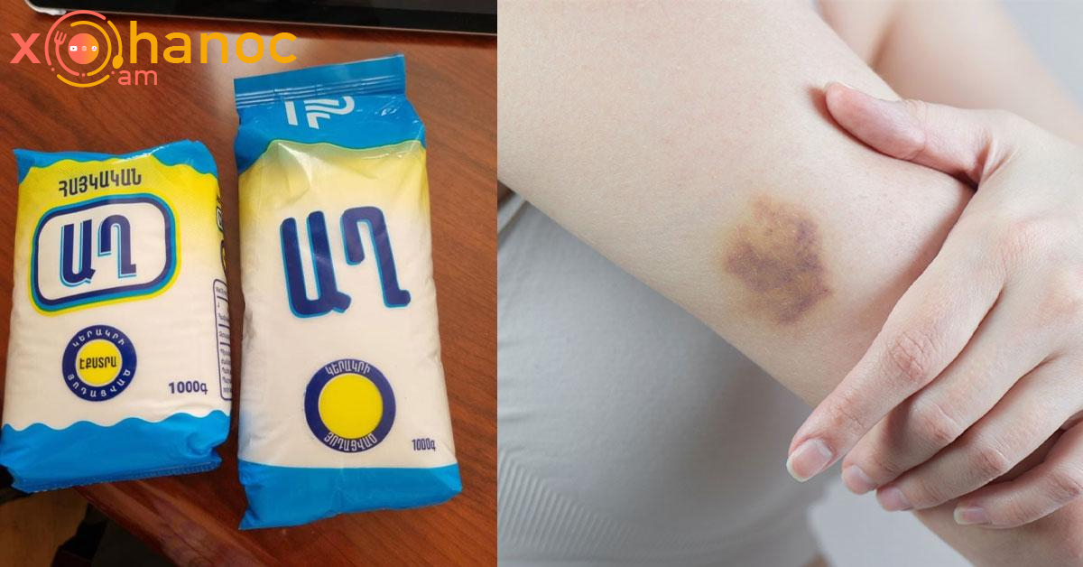 Աղը օգտագործեք այսպես և աղի միջոցով ազատվեք կապտուկներից