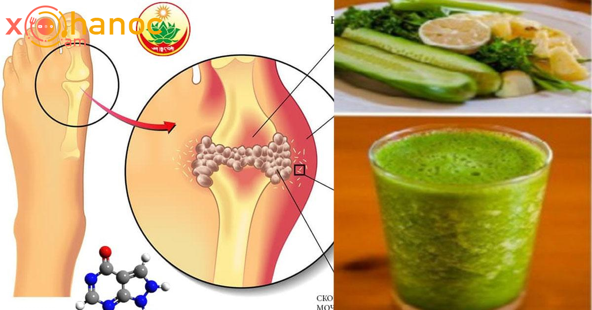Միզաթթվի բյուրեղներից ազատվելու համար խմեք այս հյութը՝ օրական 2 անգամ Միզաթթվի բյուրեղներից ազատվելու համար խմեք այս հյութը՝ օրական 2 անգամ