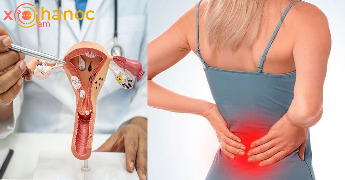 Սա ձվարաններ շատ լուրջ հիվանդության նշան է․ Կանայք և աղջիկներ, երբեք մի անտեսեք այն