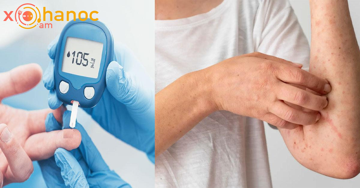 Զգուշացեք․ Սա շաքարային դիաբետի նախանշան է, պետք է դեմը շուտ առնեք