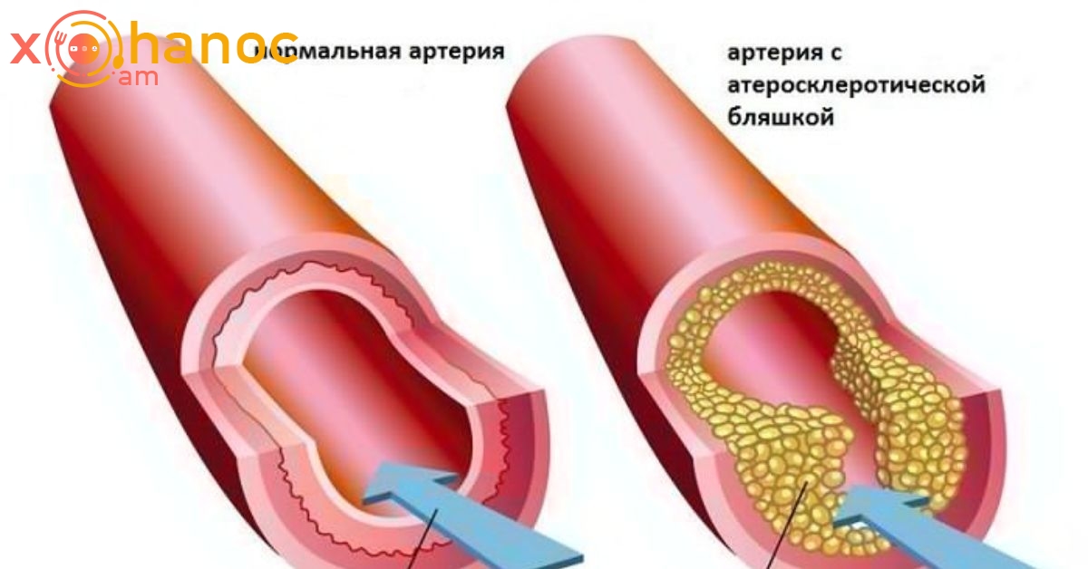 8 մթերք, որոնք մաքրում են անոթները. Փրկեք ձեզ և սիրելիներին լուրջ խնդրից