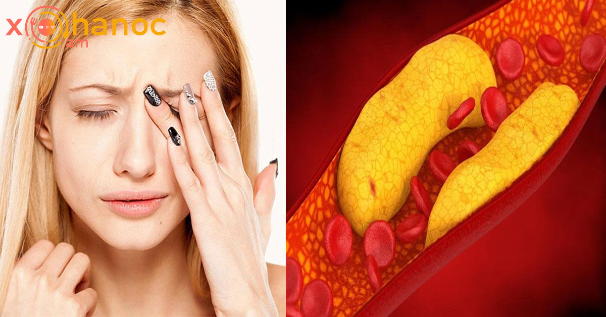 3 նշան որոնք վկայում են խոլեստերինի բարձր մակարդակ ունեք